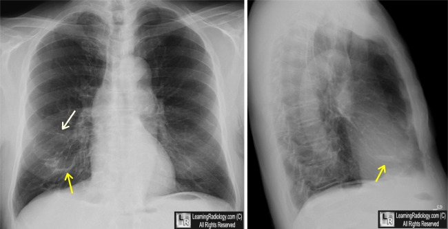 cystic bronchiectasis ct radiology